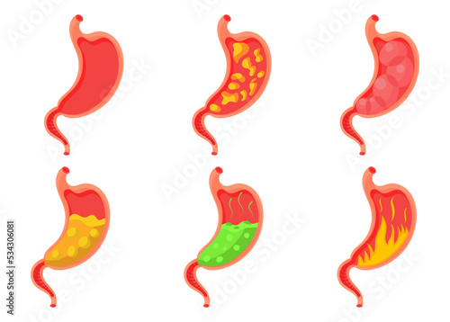 Set empty and full stomach. Heaviness of stomach, bloating, pain in the alimentary tract and acid heartburn. Duodenal problems and human organ health cartoon digestion system vector illustration.