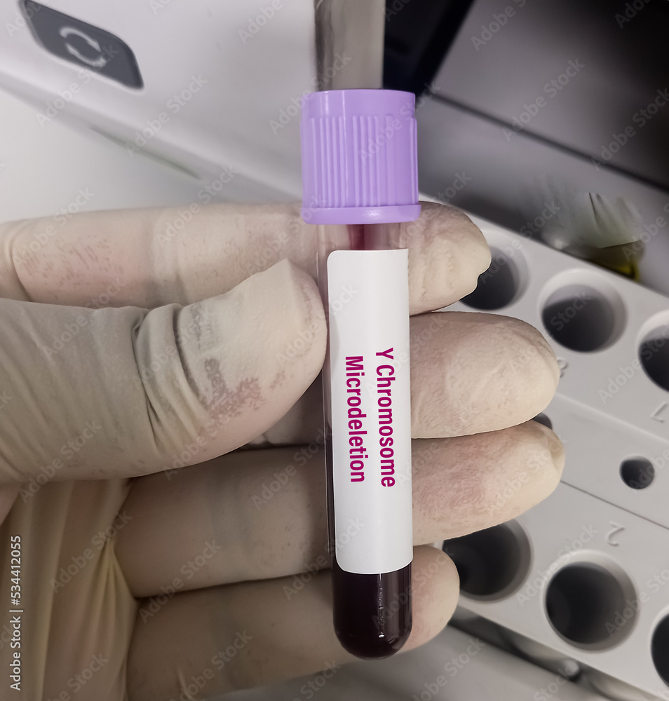 Blood sample for Y chromosome microdeletion test to identifying missing