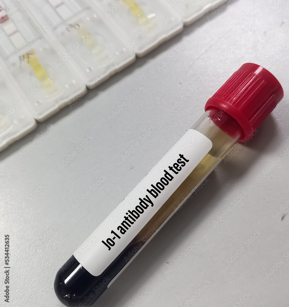 Blood sample for Jo1 antibody test to diagnosis of polymyositis. Stock