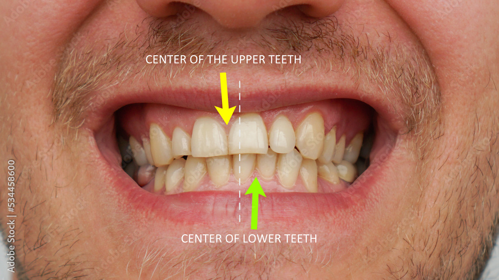 Stomatology, orthodontics. Displacement of the midline of the teeth