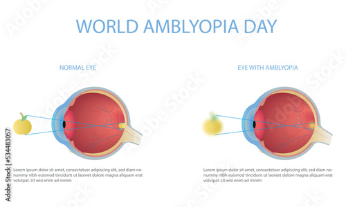 Fototapeta Naklejka Na Ścianę i Meble -  World Amblyopia Day-October 15. Eye with normal vision and eye with amblyopia.