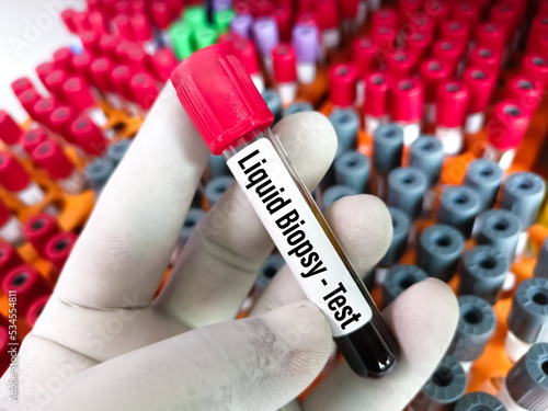 Blood samples for Liquid biopsy blood test to detect cancer cells or DNA fragments that circulate in the bloodstream, Lung cancer, laboratory background.