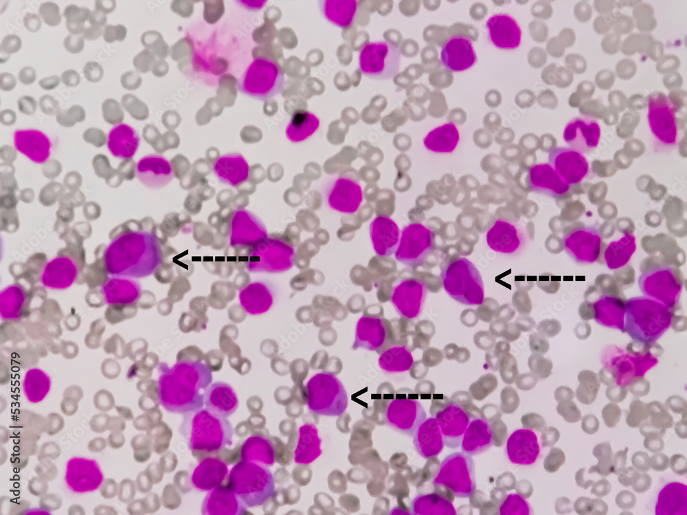 Microscopic image of bone marrow. Plasma cell dyscrasia or Multiple