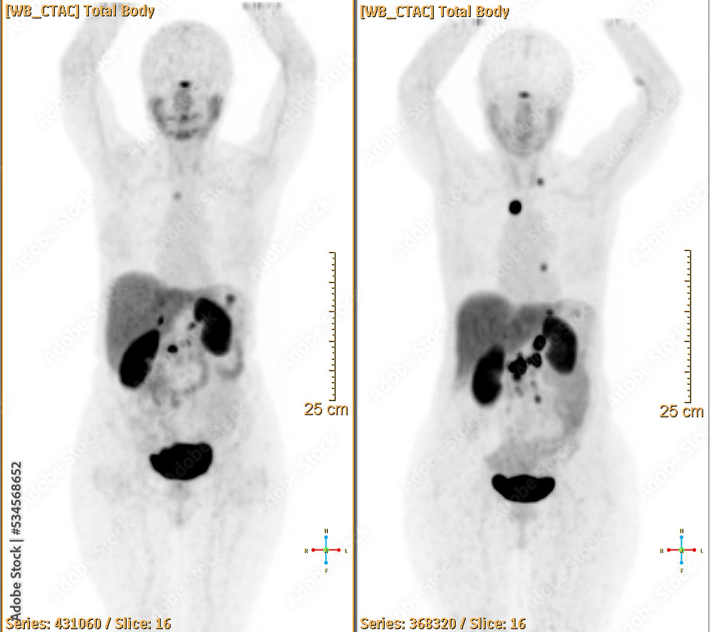 Pet Bt Ct Scan Or Nuclear Scan Image Of A Patient Showing Normal pet-bt-ct-scan-or-nuclear-scan-image-of-a-patient-showing-normal