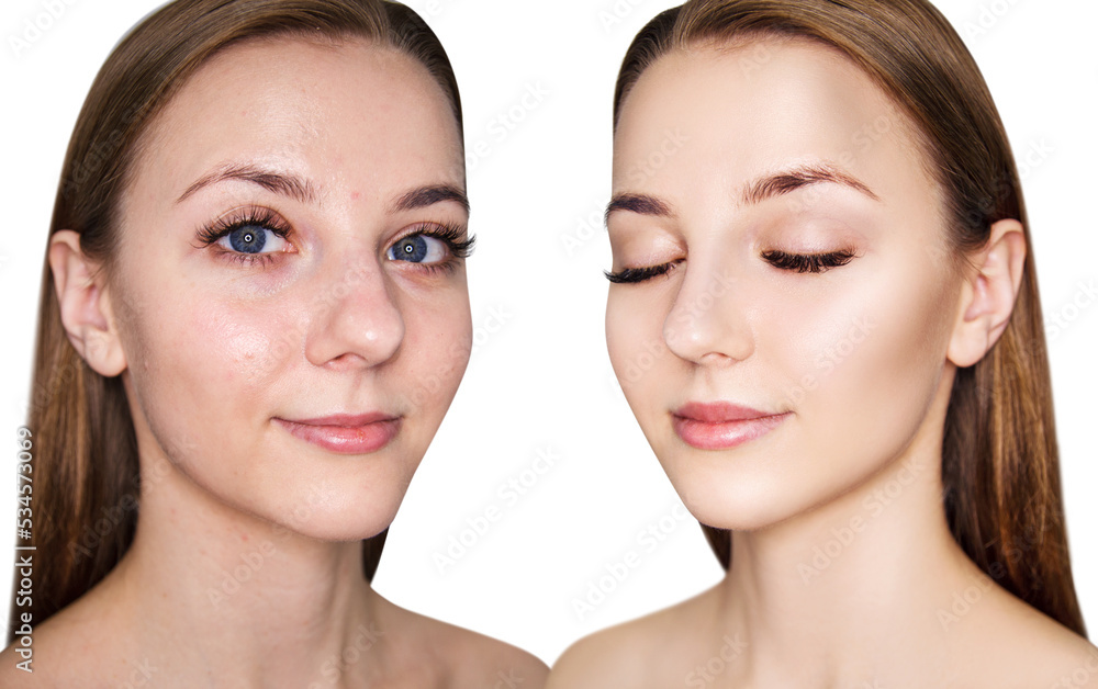 Young woman before and after acne treatment and retouch. Young woman before and after acne treatment and retouch.