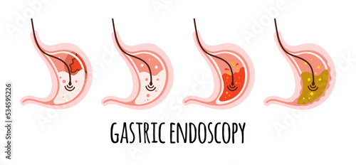 The stomach of a healthy person, with ulcers, gastritis, acidity. Gastroenterology. Vector illustration in a flat style.
