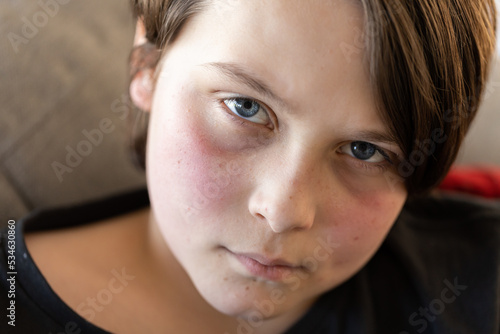 An unwell preteen boy lying on a couch looking at the camera, his cheeks are red from a fever and he looks miserable