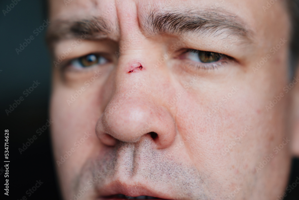close-up. bloody abrasion on the bridge of the nose of a man after a blow. close-up. bloody abrasion on the bridge of the nose of a man after a blow.