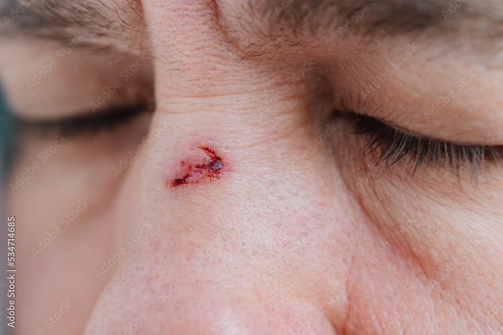 Obraz premium close-up. bloody abrasion on the bridge of the nose of a man after a blow. 