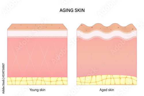 Aging skin. Comparison of young and aged skin. Facial skin problems. Vector for advertising about beauty and medical treatment.