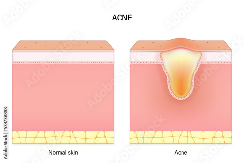 Acne. Comparison of normal skin and acne. Facial skin problems. Vector for advertising about beauty and medical treatment.