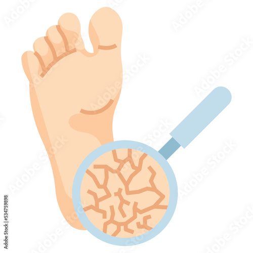 cracked heels