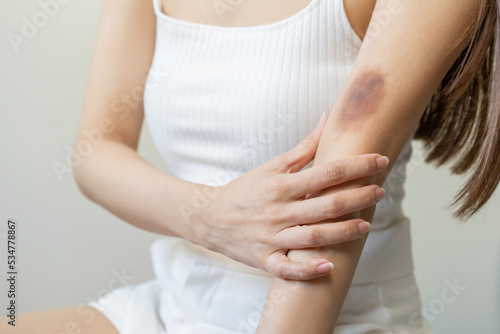 Close up of stain bruise wound on her arm  contusion asian young woman  girl an accident fell down stairs at home  hand in healing injury by massage hematoma blood. Extravasation blue  purple on skin.
