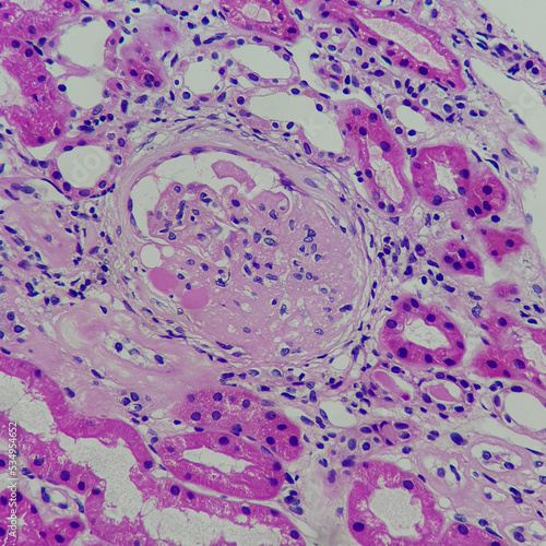 Camera photo of focal segmental glomerulosclerosis, showing segmental obliteration of capillary lumen, magnification 400x, HE stain