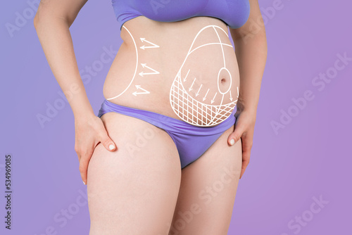 Abdomen liposuction, fat and cellulite removal concept, overweight female body with painted surgical lines and arrows