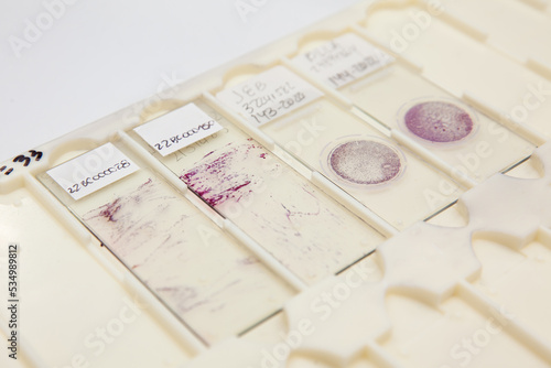 Traditional and liquid based cytology microscope slides for pap smear test. Cervical cancer concept. Medical concept. photo