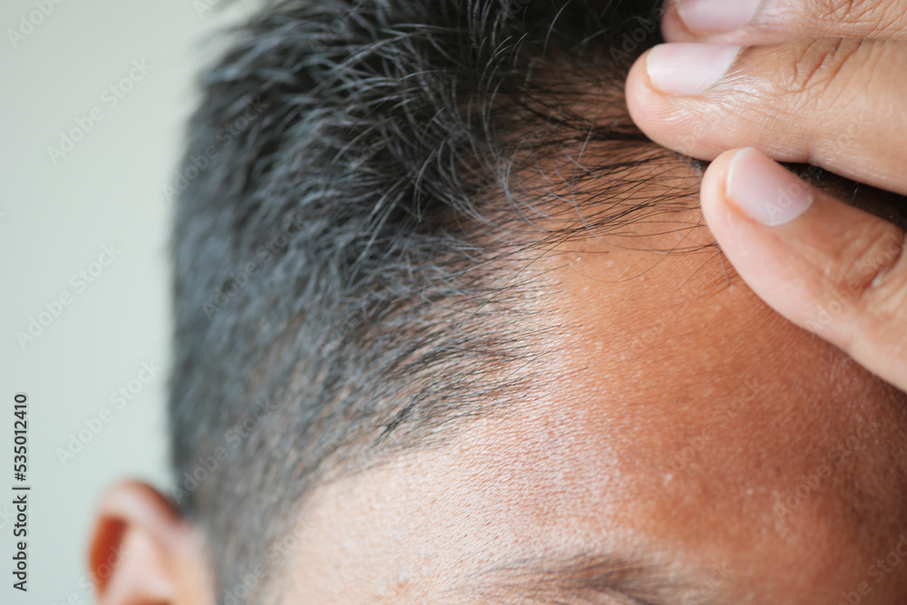 hair loss concept with man checking his hair hair loss concept with man checking his hair