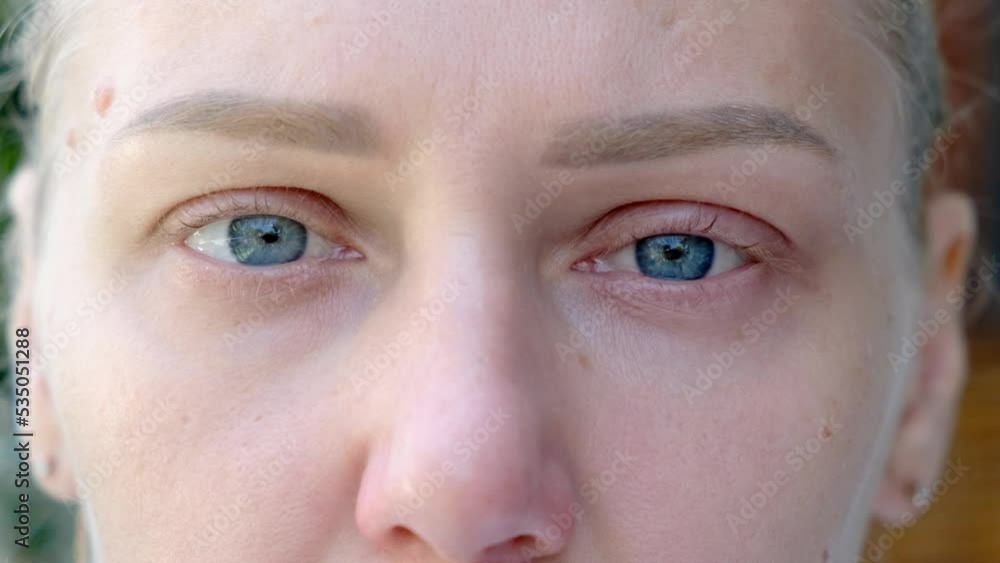 Macro shot of sad blue eyes and swollen eyelids. Young beautiful blonde looks into camera. Eyes of girl with long beautiful eyelashes. Close-up of caucasian woman. Conjunctivitis, allergies or colds Macro shot of sad blue eyes and swollen eyelids. Young beautiful blonde looks into camera. Eyes of girl with long beautiful eyelashes. Close-up of caucasian woman. Conjunctivitis, allergies or colds