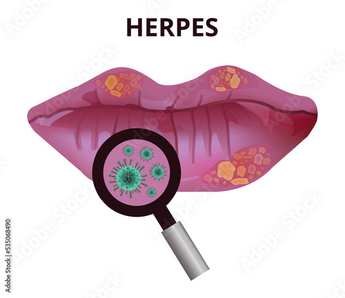 Vector medical illustration of herpes labialis, cold sores or fever blisters on lips with a magnifying glass zooming in on the close-up viruses. Viral infection caused by herpes simplex virus isolated