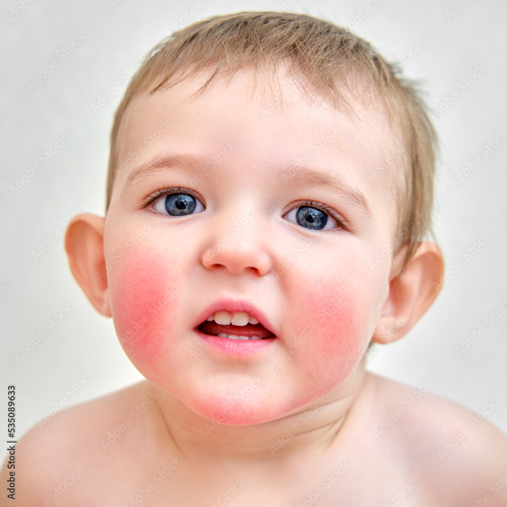 Portrait of a child with allergies on the cheeks and chin. Toddler baby