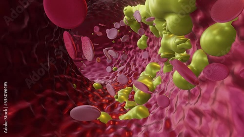 Cholesterol Buildup Blood Vessel (Closeup) photo
