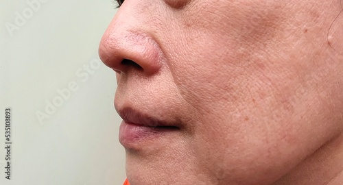 Portrait showing the flabbiness adipose sagging skin, dark spots and blemish on the cheek, dull skin and wrinkles corner of the mouth, Flabby skin on the face of the woman, concept health care.