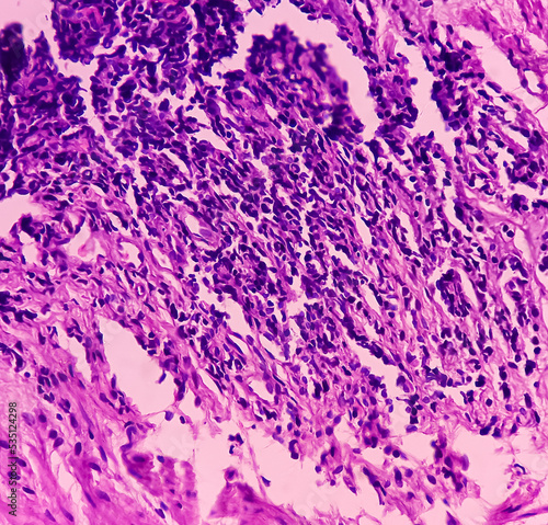 Tissue from rectum(colonoscopic biopsy):  Chronic nonspecific proctitis. Show rectal mucosa, dense infiltration of lymphocytes, histiocytes and plasma cell in lamina propria. IBD. photo