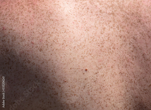 Freckle on the back of a man.