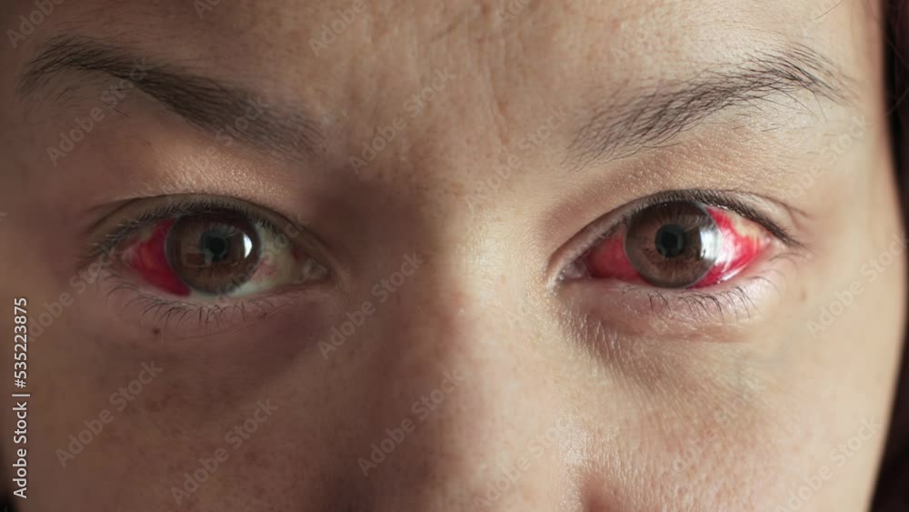 Female red eyes filled with blood. Burst capillary vessels