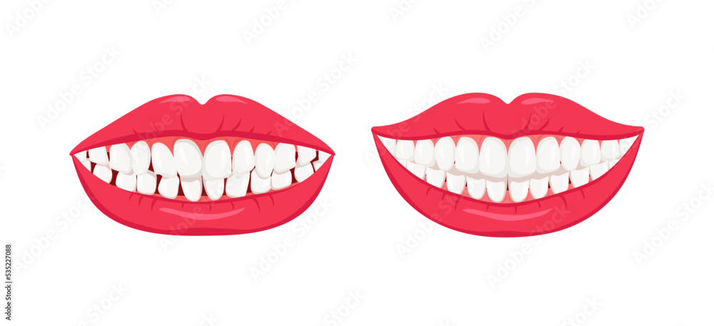 Obraz premium Healthy straight and diseased crooked teeth. Proper care for a beautiful smile and white misaligned teeth with orthodontic bruxism and need for dental vector correction