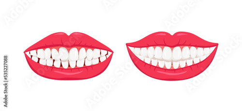Healthy straight and diseased crooked teeth. Proper care for a beautiful smile and white misaligned teeth with orthodontic bruxism and need for dental vector correction