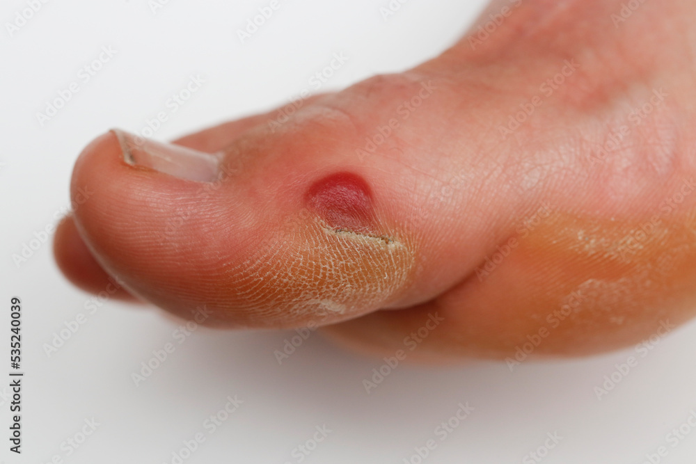 Fototapeta premium Une ampoule de sang sur le pied d'une coureuse