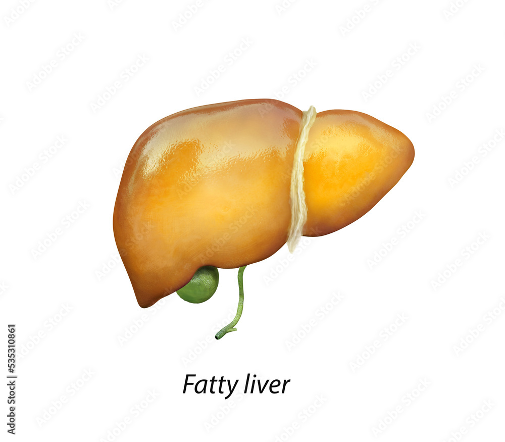 Fatty liver, liver steatosis, 3D illustration and photomicrograph showing large vacuoles of triglyceride fat accumulated inside liver cells, it occurs in alcohol overuse, under action of toxins - obrazy, fototapety, plakaty 
