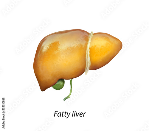 Fatty liver, liver steatosis, 3D illustration and photomicrograph showing large vacuoles of triglyceride fat accumulated inside liver cells, it occurs in alcohol overuse, under action of toxins photo