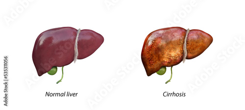 Normal liver versus liver with Cirrhosis, damaged liver, excessive drinking of alcohol, treatment,
