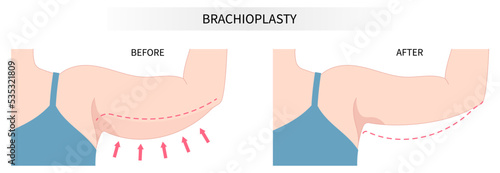 Fototapeta extra skin reducing with brachioplasty Remove contouring