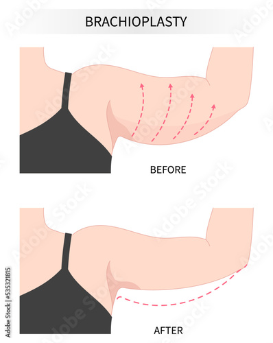 brachioplasty Remove contouring extra skin reducing