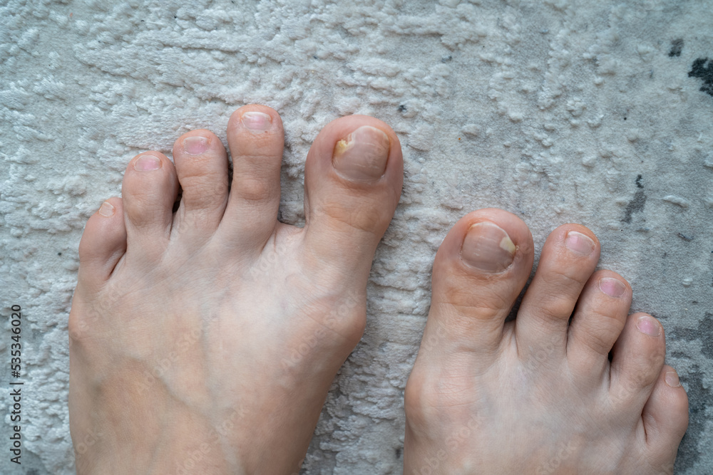person feet close up, fungus, broken nail, skin infection, toe mycosis