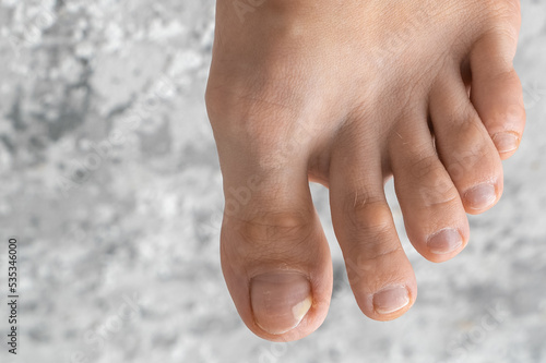 person feet close up, fungus, broken nail, skin infection, toe mycosis, treatment needed, fungal infection concept, onychomycosis, onycholysis, nail separates from nail bed, separated 