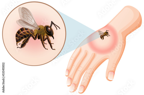 Bee bites sting on skin