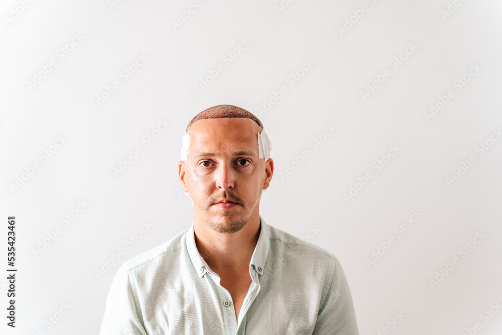 After hair transplantation surgical technique that moves hair follicles. Young bald man in bandage with hair loss problems. White background with copy space. After hair transplantation surgical technique that moves hair follicles. Young bald man in bandage with hair loss problems. White background with copy space.