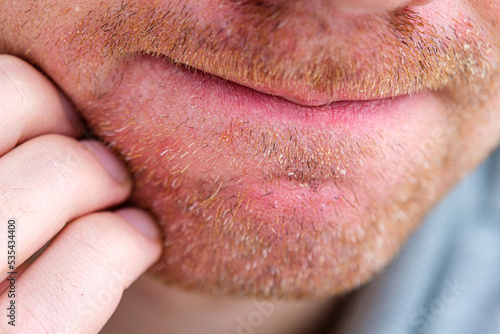 Seborrheic dermatitis or eczema on adult man face isolated close up.