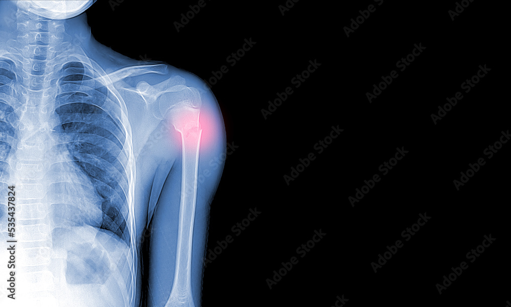 xray images of the shoulder joint to see injuries bones fractures and
