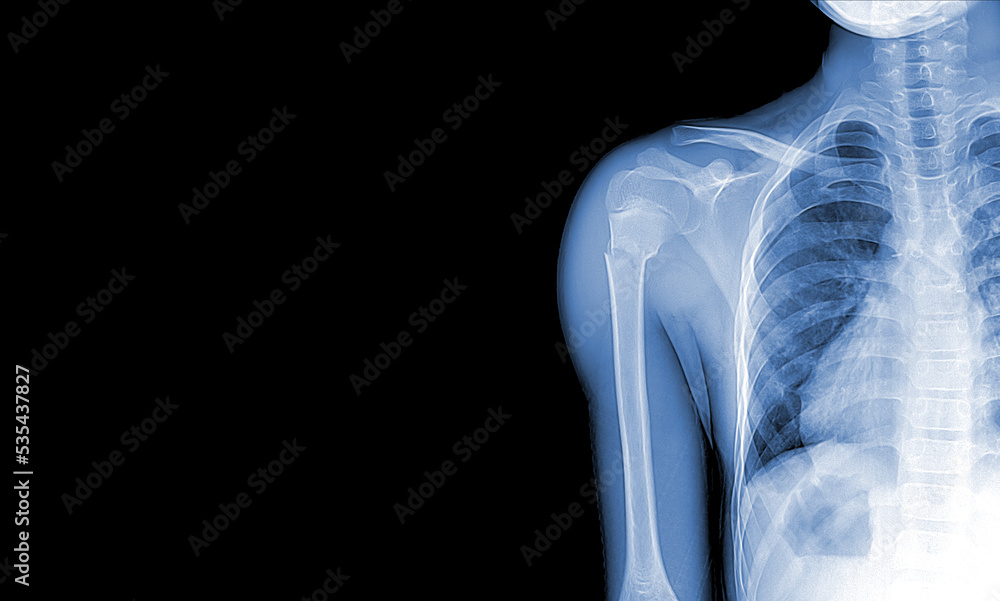 xray images of the shoulder joint to see injuries bones fractures and