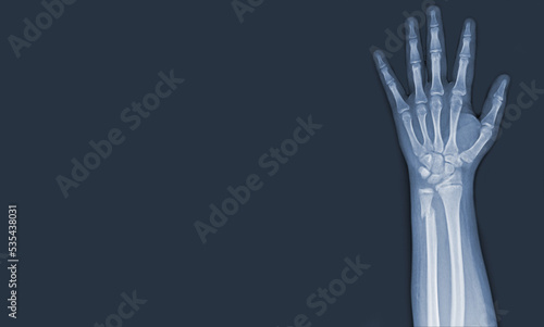 x-ray images of the hand and wrist joint to see injuries tendons and ulna bone fracture for a medical diagnosis.Medical image concept and copy space.