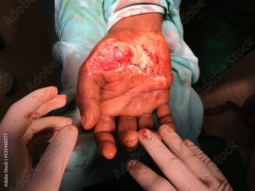 Right hand palm laceration with tissue loss repaired with sutures allowing loss tissues to granulate photo