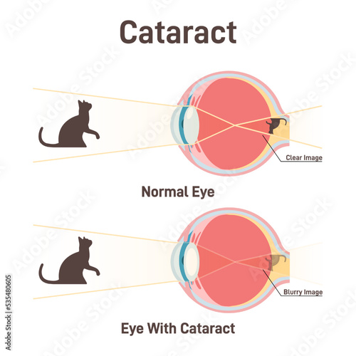 Cataract. Clouding of the lens, decrease of vision. Anatomical cross