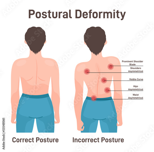 Postural deformity. Scoliosis, curvature illness of spine. Body posture defect