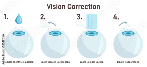 Vision correction. Laser eye surgery. Ophthalmology procedure.