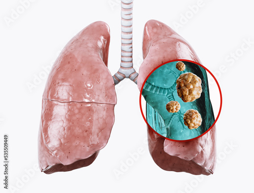 Human lungs damaged by cancer. 3d illustration of lung with cancer tissue